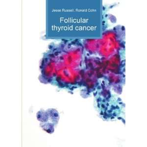  Follicular thyroid cancer: Ronald Cohn Jesse Russell 