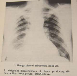Medical Book Asbestos Bodies in Human Lungs at Autopsy  